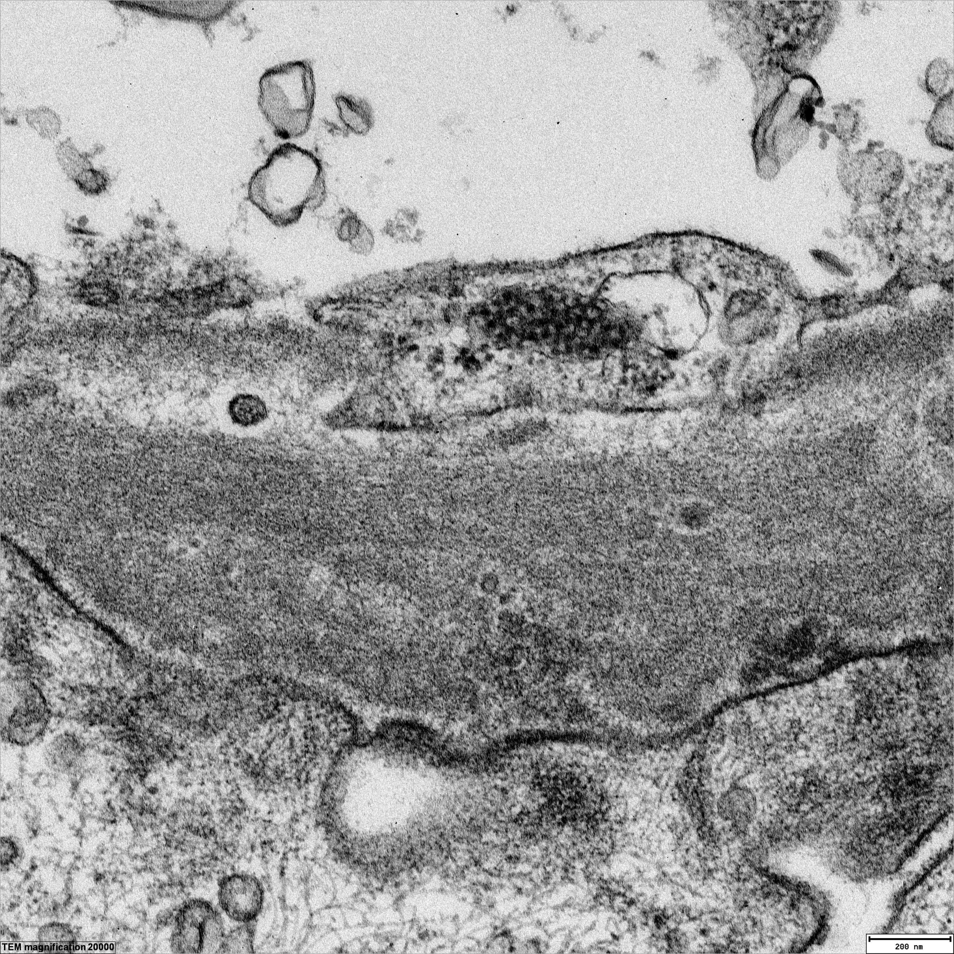 Tubulo-retikuläre Strukturen einer Endothelzelle bei Lupus erythematodes (TEM, x20000) Tubulo-retikuläre Strukturen einer Endothelzelle bei Lupus erythematodes (TEM, x20000)